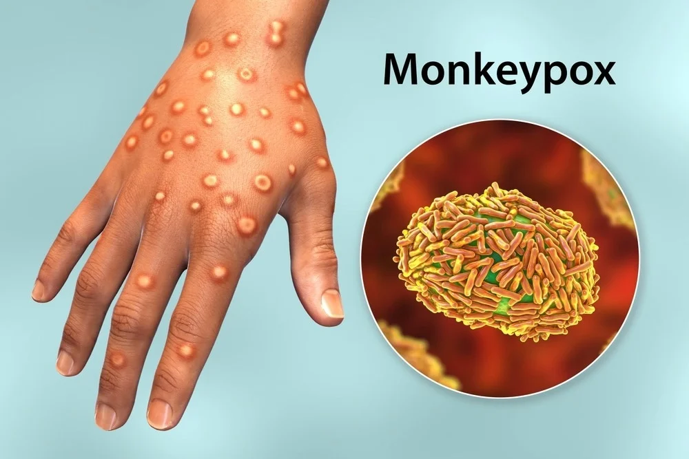 Monkeypox (Mpox)