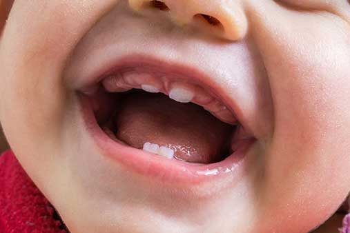 Natal and Neonatal teeth